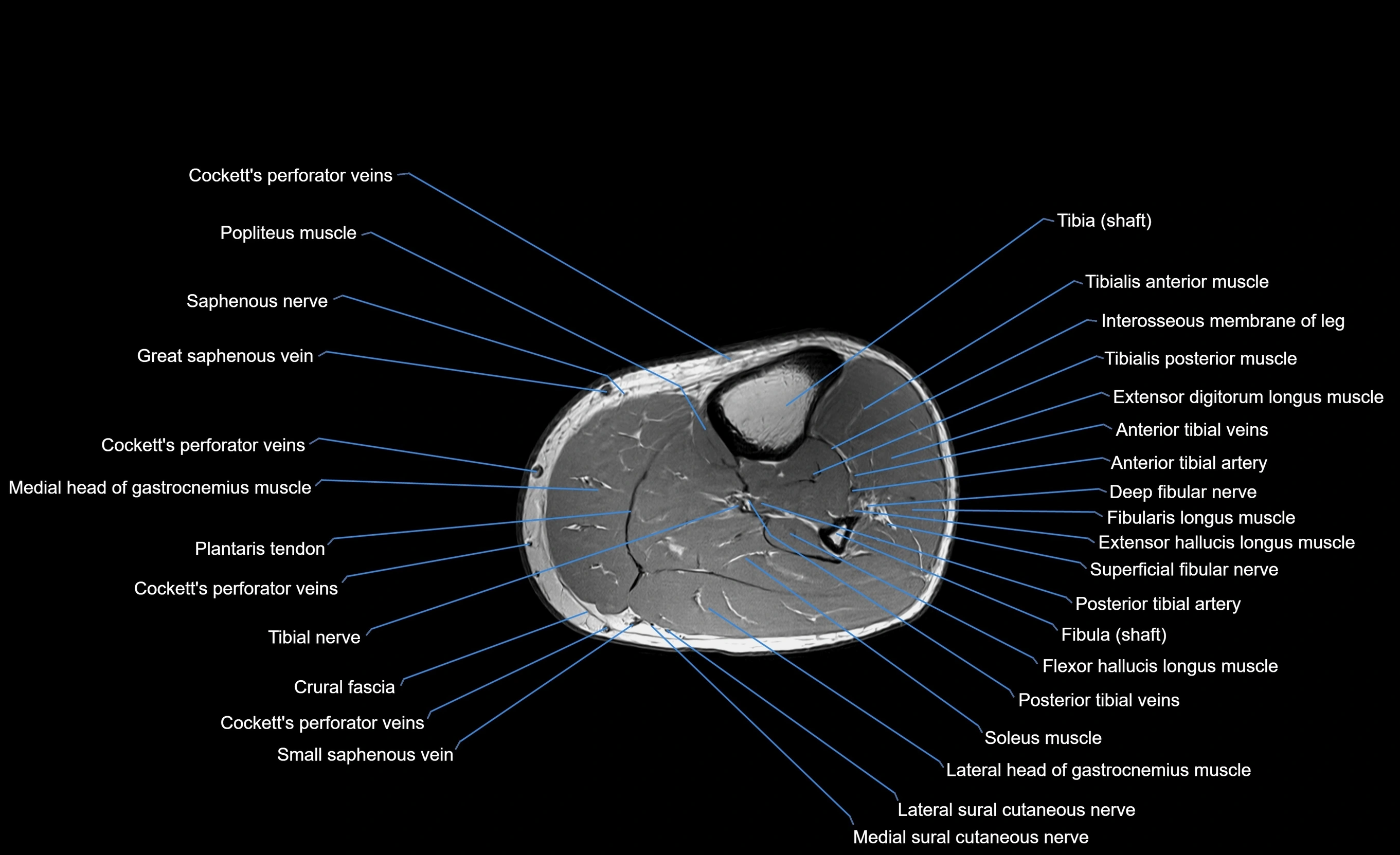 MRI lower leg axial cross sectional anatomy 3T  radiology  image-img-00001-00032.webp